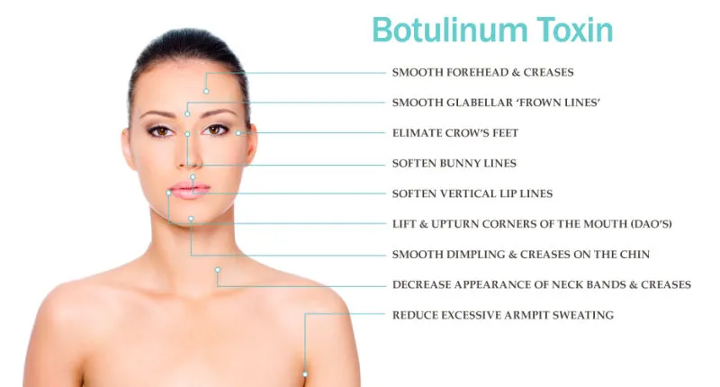 Μείωση του βάρους Αντί ρυτίδων Beutox Batulaxs Resty Dermal Filler Juvederms 0