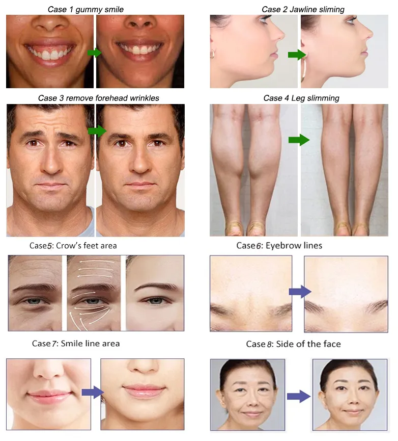 Μείωση του βάρους Αντί ρυτίδων Beutox Batulaxs Resty Dermal Filler Juvederms 1